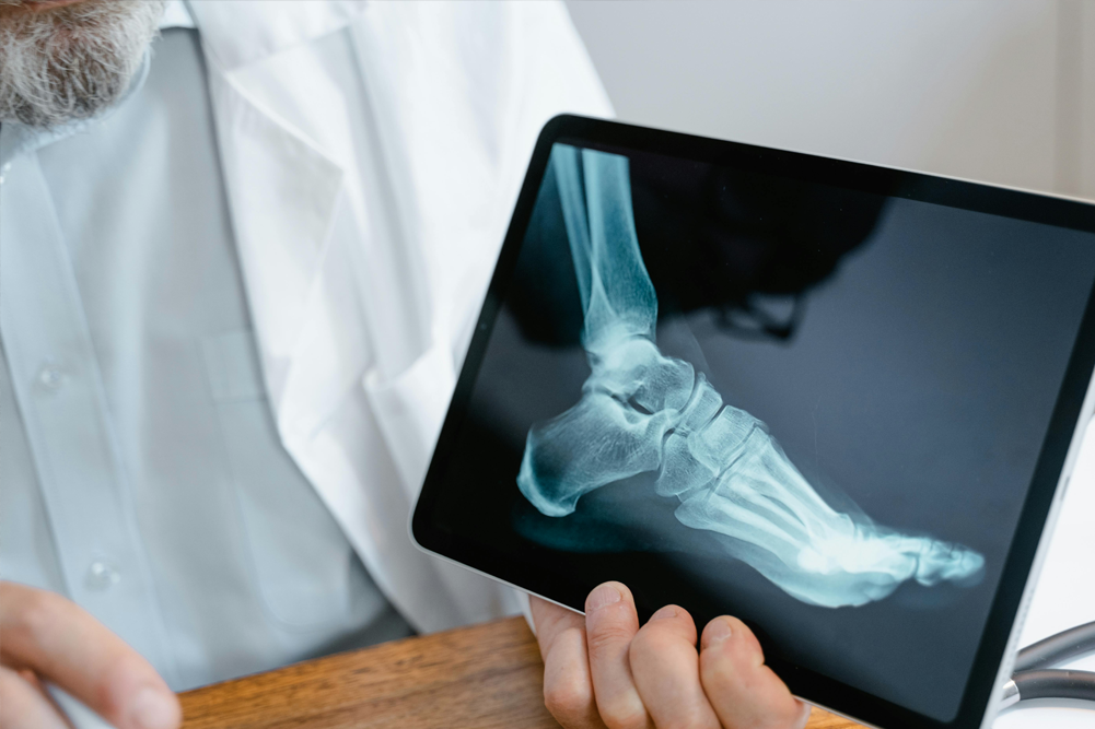 Calcium in the blood or urine? What can it tell you about bone loss?